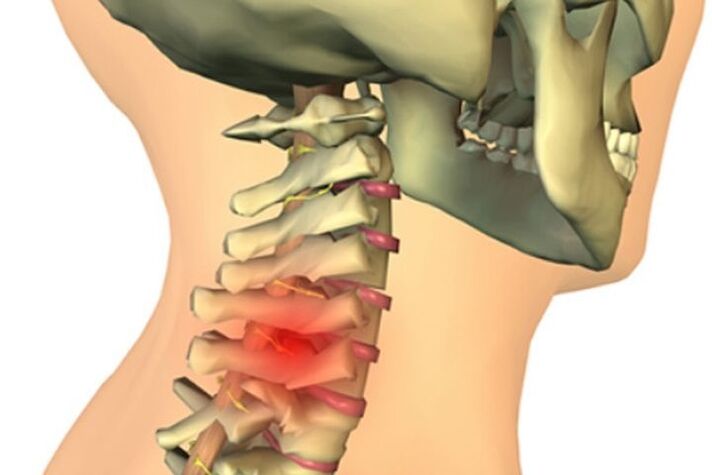 骨关节炎引起的颈部疼痛