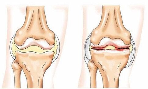 健康和关节炎的膝关节